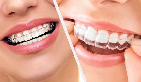 ارتودنسی نامرئی در قم | کلینیک دندانپزشکی پارسیان 9 images 1694068852 64f97074368a0