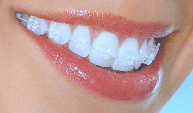 ارتودنسی نامرئی در قم | کلینیک دندانپزشکی پارسیان 6 Invisible Braces Available