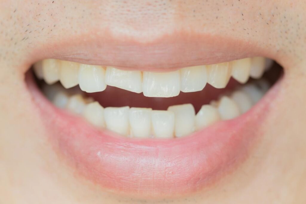 لمینت 7 cracked tooth example