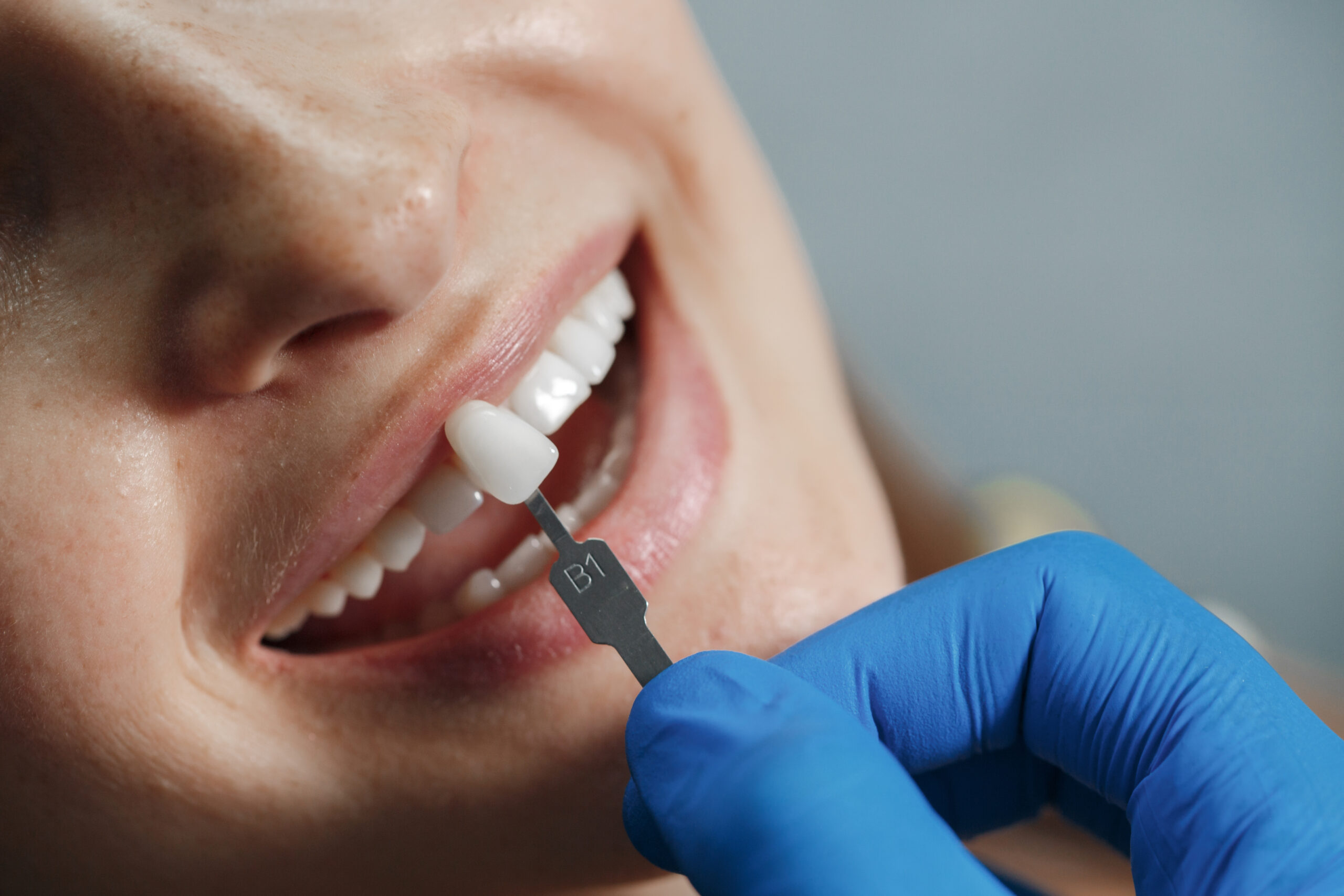 لمینت 13 dentist whiting teeth scaled
