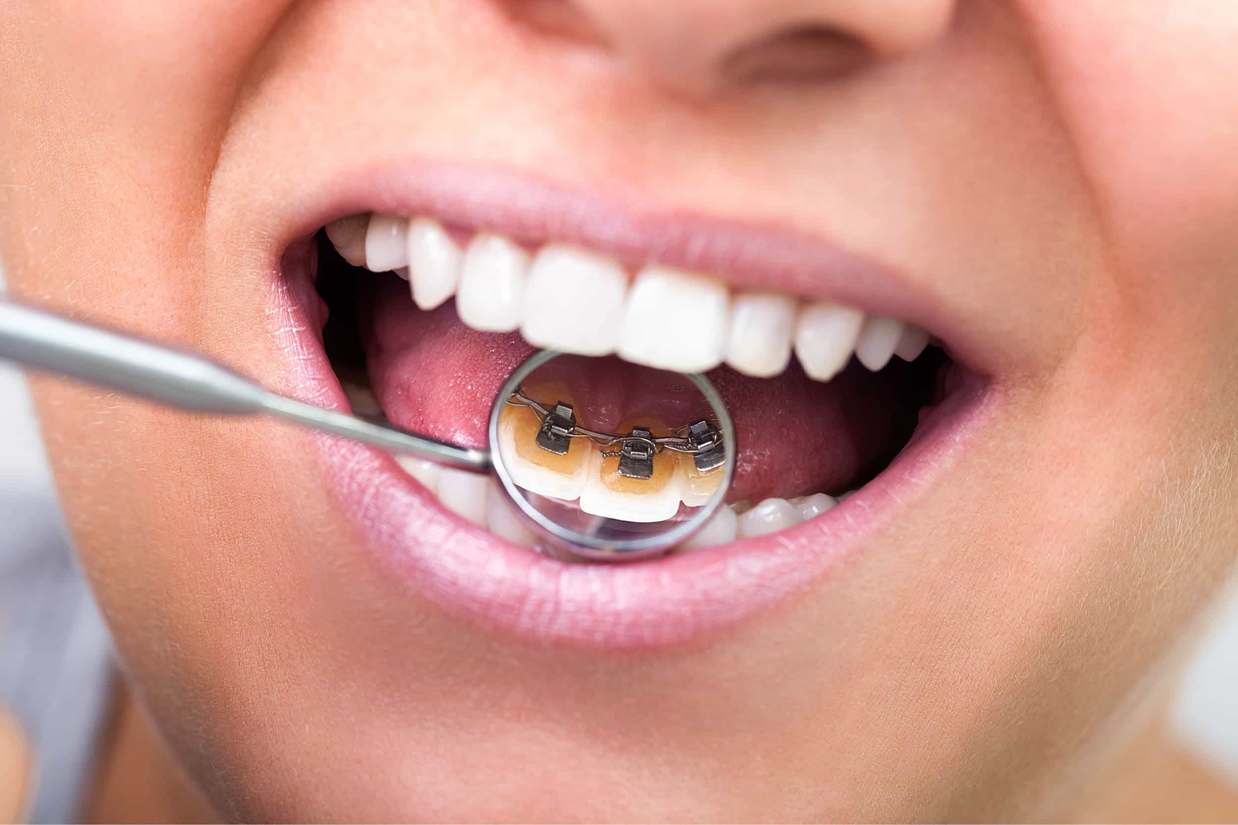 ارتودنسی نامرئی در قم | کلینیک دندانپزشکی پارسیان 7 lingual orthodontics materials procedures