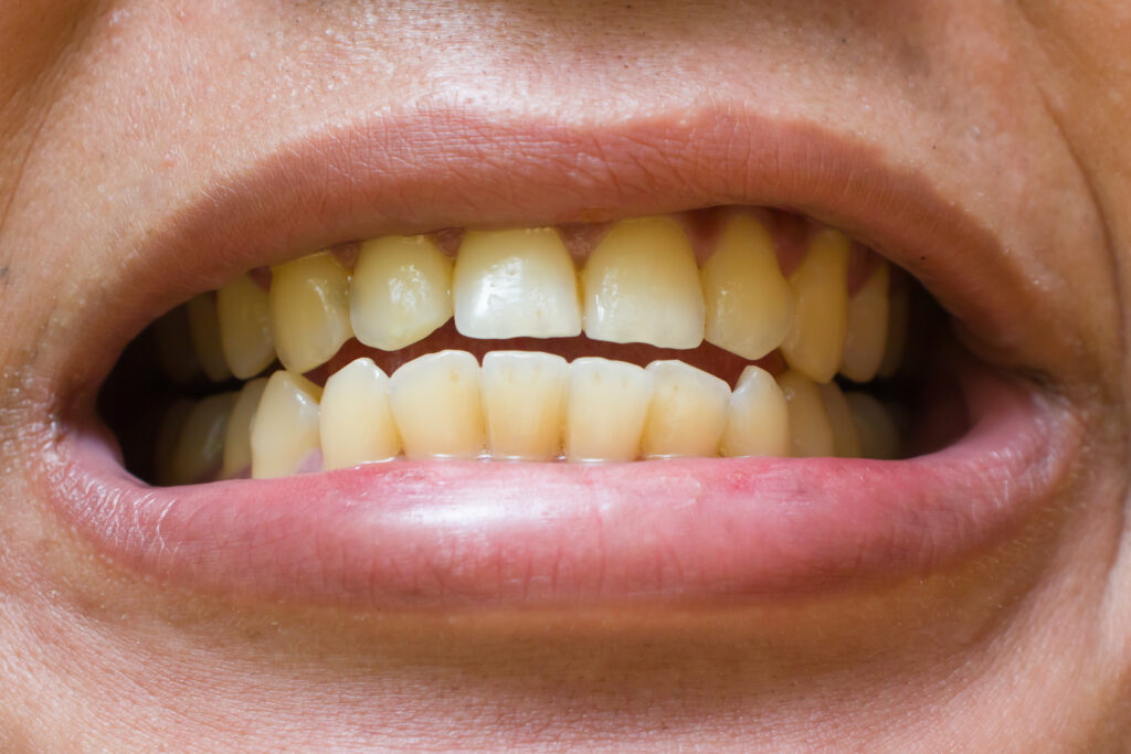 لمینت 6 vecteezy a man s teeth are yellow 7321219