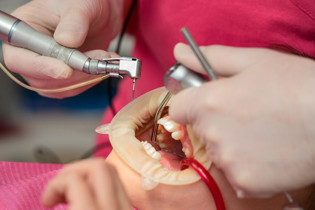 بلیچینگ 5 vecteezy dentist cleans tooth decay in a child with a drill in the 13677505