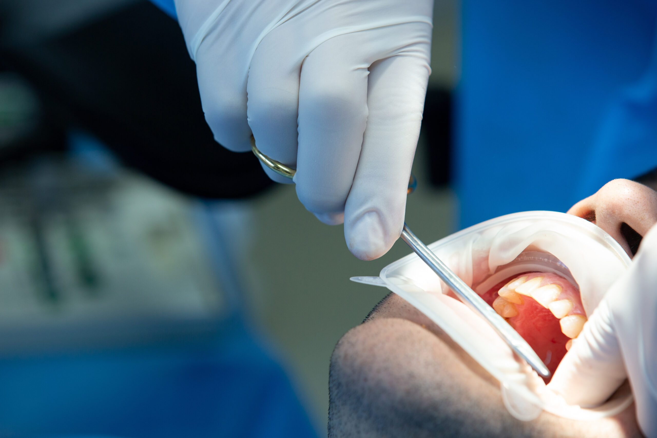 لمینت 11 dentist with tool makes some manipulations patient s mouth scaled