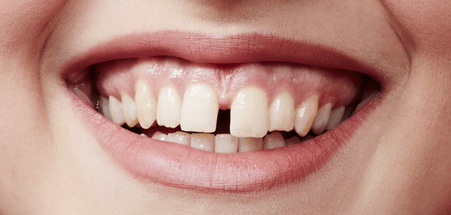 لمینت 8 teeth bankedandan