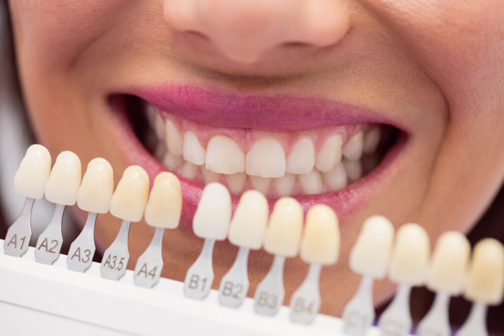 لمینت 16 dentist examining female patient with teeth shades