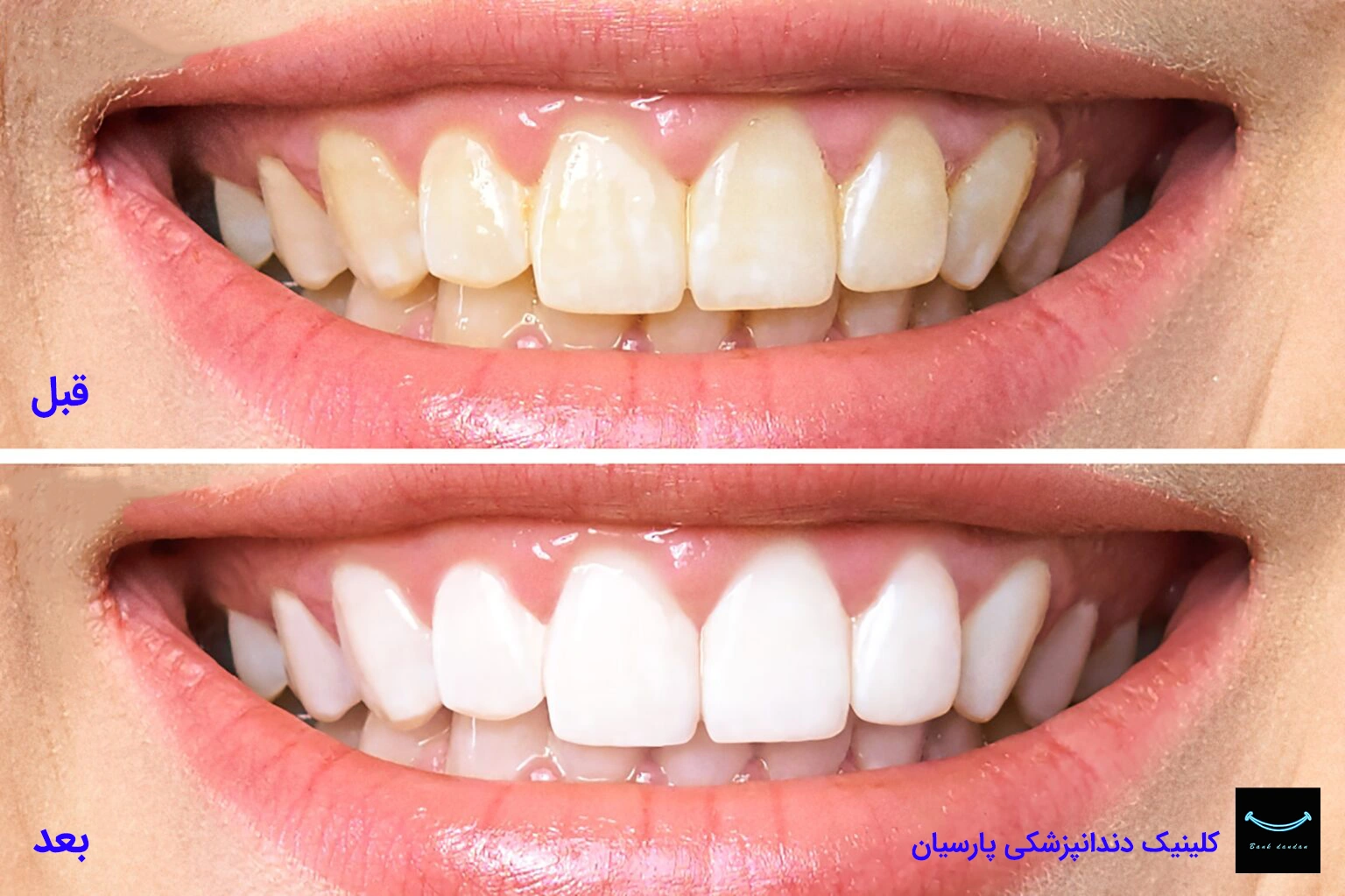 مجله 1 بلیچینگ دندان در خانه یا کلینیک؟ مقایسه کامل دو روش پرطرفدار سفید کردن دندان